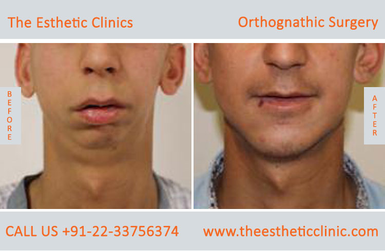 Orthognathic Surgery, Jaw Correction Surgery before after photos in mumbai india (1)